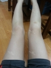 Lower body thigh liposuction — Korea cost, reviews & before-after | MISOODA