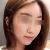 Nose Bridge + Tip Augmentation — Korea cost, reviews & before-after | MISOODA