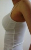 Teardrop implant breast augmentation — Korea cost, reviews & before-after | MISOODA