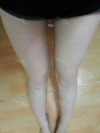 Lower body thigh liposuction — Korea cost, reviews & before-after | MISOODA