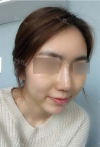Nose Bridge + Tip Augmentation — Korea cost, reviews & before-after | MISOODA