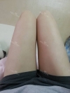 Lower body thigh liposuction — Korea cost, reviews & before-after | MISOODA