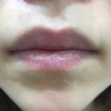 Lip(corner) filler injection — Korea cost, reviews & before-after | MISOODA