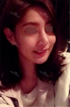 Nose Revision... — Korea cost, reviews & before-after | MISOODA