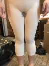 Liposcution surgery — Korea cost, reviews & before-after | MISOODA