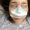 Nose Revision... — Korea cost, reviews & before-after | MISOODA