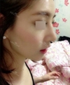 Nose Revision... — Korea cost, reviews & before-after | MISOODA