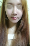 Rhinoplasty~! — Korea cost, reviews & before-after | MISOODA