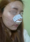 Rhinoplasty~! — Korea cost, reviews & before-after | MISOODA
