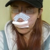 Rhinoplasty~! — Korea cost, reviews & before-after | MISOODA