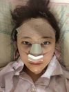 Nose job for confidence! — Korea cost, reviews & before-after | MISOODA