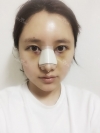 Nose job for confidence! — Korea cost, reviews & before-after | MISOODA