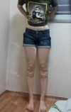 Thighs liposuction 1 — Korea cost, reviews & before-after | MISOODA