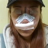 Rhinoplasty~! — Korea cost, reviews & before-after | MISOODA