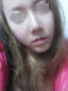 Rhinoplasty~! — Korea cost, reviews & before-after | MISOODA