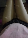 Thighs liposuction 1 — Korea cost, reviews & before-after | MISOODA