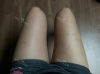 Thighs liposuction 2 — Korea cost, reviews & before-after | MISOODA