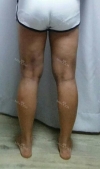 Thighs liposuction 2 — Korea cost, reviews & before-after | MISOODA
