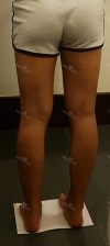 Thighs liposuction 2 — Korea cost, reviews & before-after | MISOODA