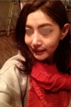 Nose Revision... — Korea cost, reviews & before-after | MISOODA