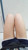 Thighs liposuction — Korea cost, reviews & before-after | MISOODA