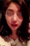 Nose Revision... — Korea cost, reviews & before-after | MISOODA