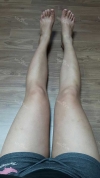 Thighs liposuction 2 — Korea cost, reviews & before-after | MISOODA