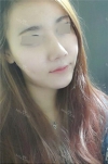 Rhinoplasty~! — Korea cost, reviews & before-after | MISOODA