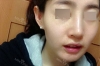 Nose Revision... — Korea cost, reviews & before-after | MISOODA