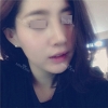 Nose Revision... — Korea cost, reviews & before-after | MISOODA