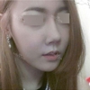 Rhinoplasty~! — Korea cost, reviews & before-after | MISOODA