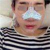 Nose Revision... — Korea cost, reviews & before-after | MISOODA