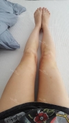 Thighs liposuction — Korea cost, reviews & before-after | MISOODA