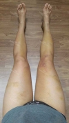 Thighs liposuction 2 — Korea cost, reviews & before-after | MISOODA