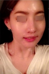 Nose Revision... — Korea cost, reviews & before-after | MISOODA