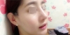 Nose Revision... — Korea cost, reviews & before-after | MISOODA
