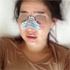 Nose Revision... — Korea cost, reviews & before-after | MISOODA