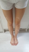 Thighs liposuction — Korea cost, reviews & before-after | MISOODA