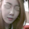 Rhinoplasty~! — Korea cost, reviews & before-after | MISOODA