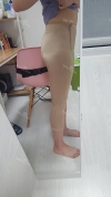 Thighs liposuction — Korea cost, reviews & before-after | MISOODA