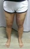 Thighs liposuction 2 — Korea cost, reviews & before-after | MISOODA