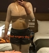 Liposcution surgery — Korea cost, reviews & before-after | MISOODA