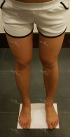 Thighs liposuction 2 — Korea cost, reviews & before-after | MISOODA