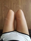 Thighs liposuction 2 — Korea cost, reviews & before-after | MISOODA