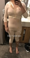 Liposcution surgery — Korea cost, reviews & before-after | MISOODA
