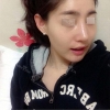 Nose Revision... — Korea cost, reviews & before-after | MISOODA
