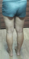Thighs liposuction 2 — Korea cost, reviews & before-after | MISOODA