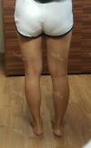 Thighs liposuction 2 — Korea cost, reviews & before-after | MISOODA