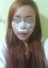 Rhinoplasty~! — Korea cost, reviews & before-after | MISOODA