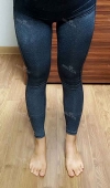 Thighs liposuction 2 — Korea cost, reviews & before-after | MISOODA